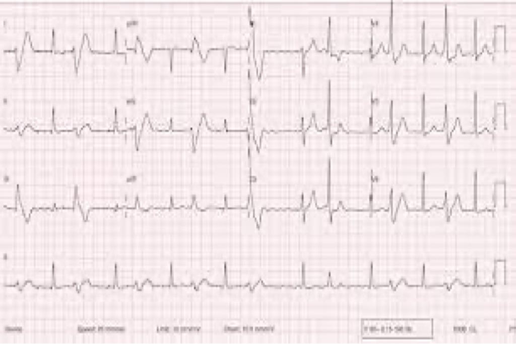 Ventricular Extrasystole Ablation